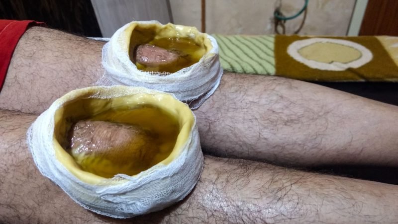 ayurvedic therapy for knee pain